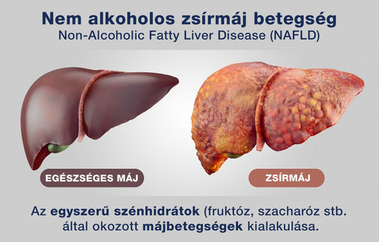 Nem alkoholos zsírmáj betegség